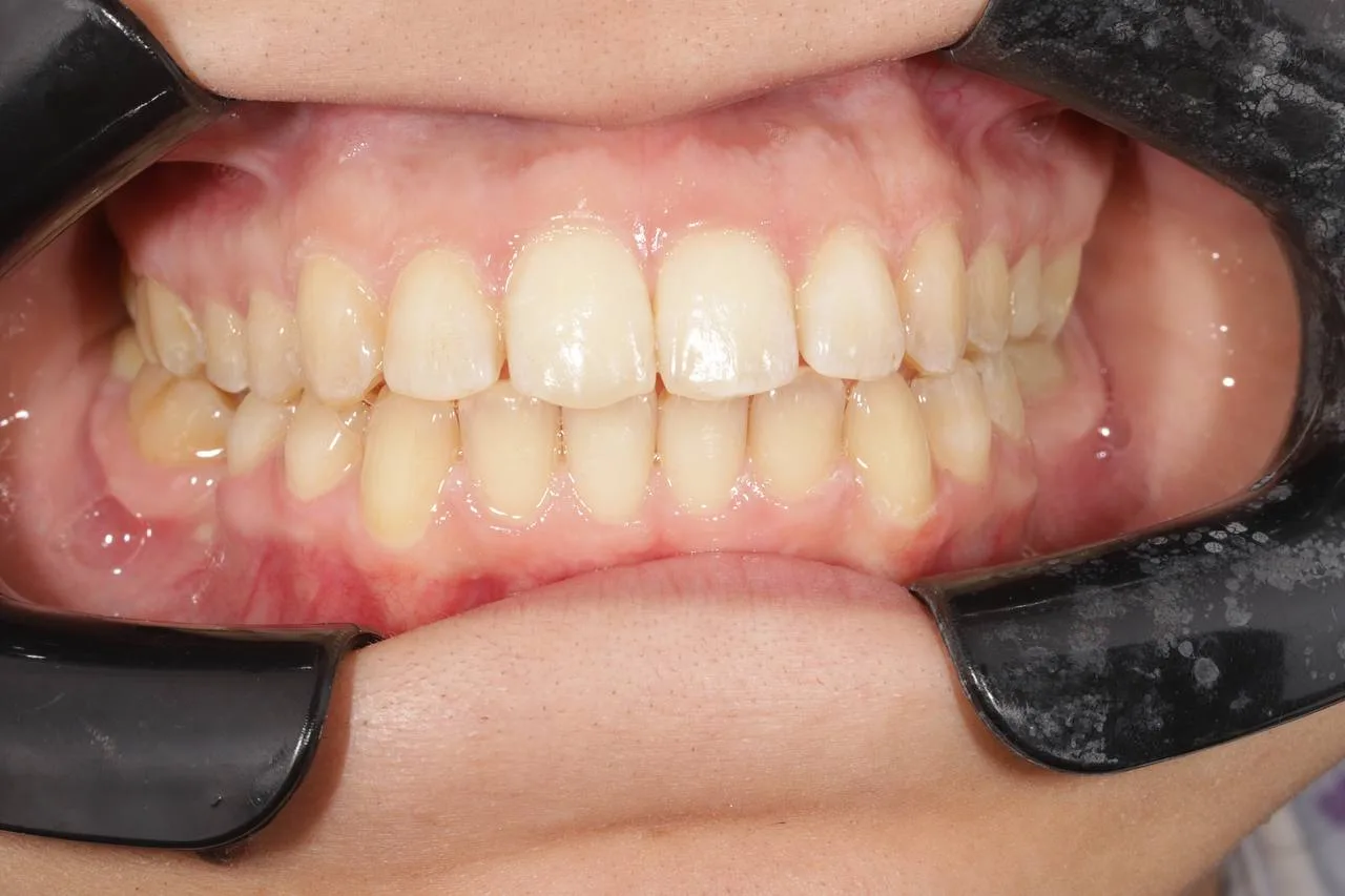 Clear aligner case — After