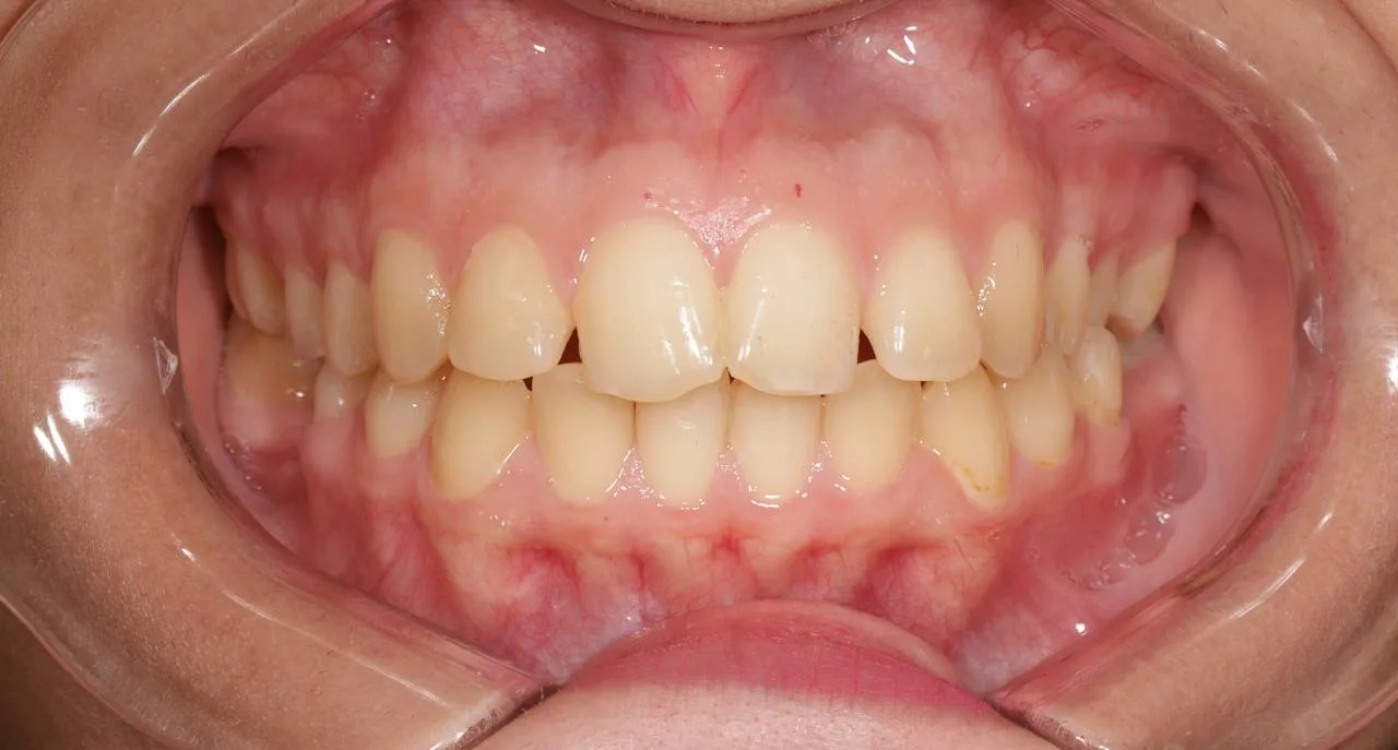Clear aligner case — Before