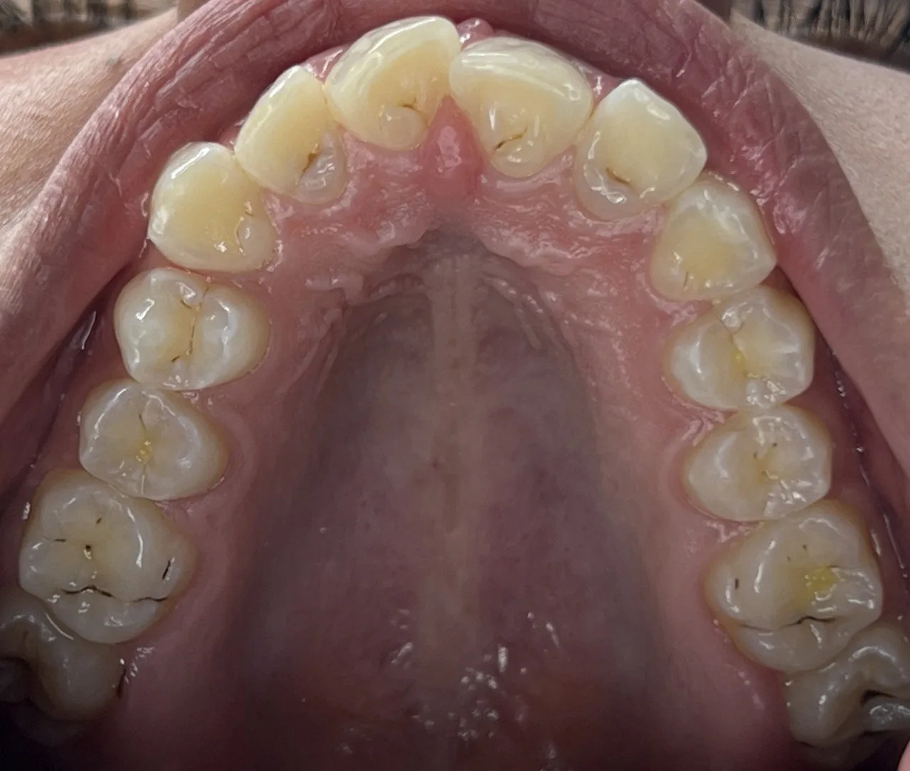 Clear aligner case — Before