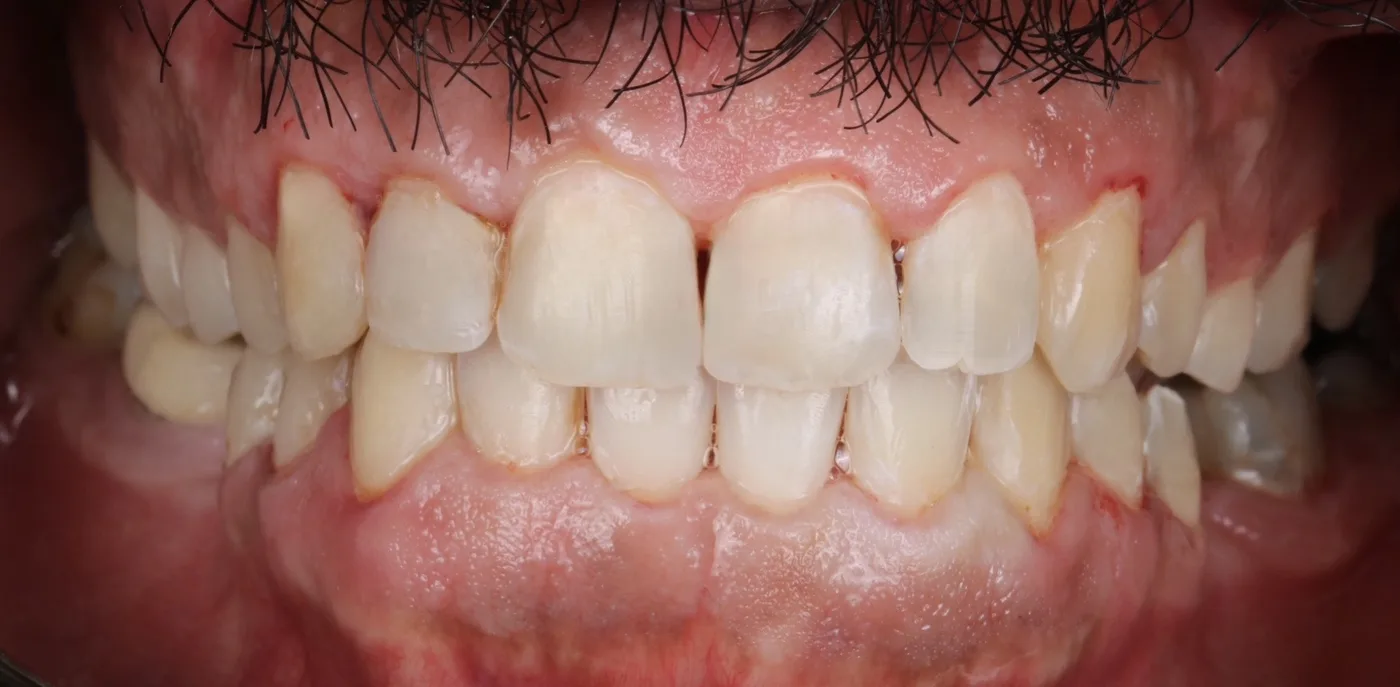 Clear aligner case — After