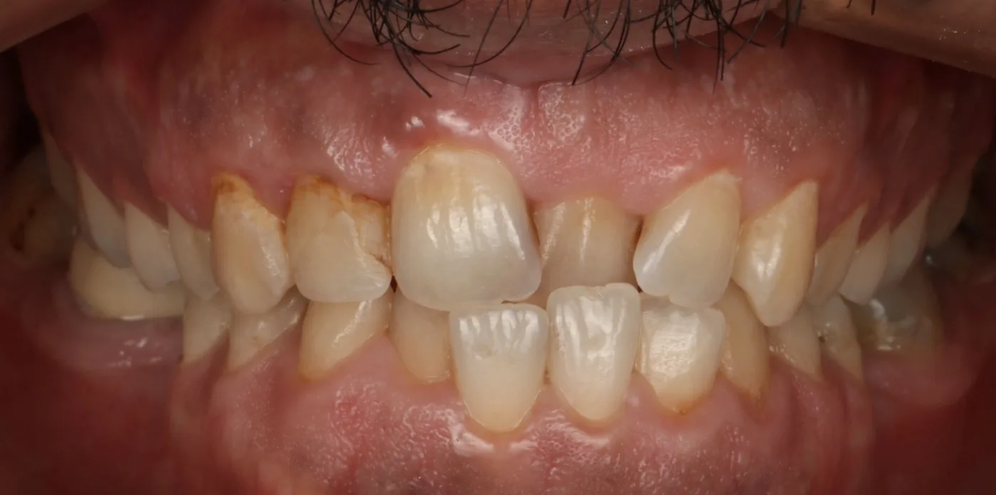Clear aligner case — Before