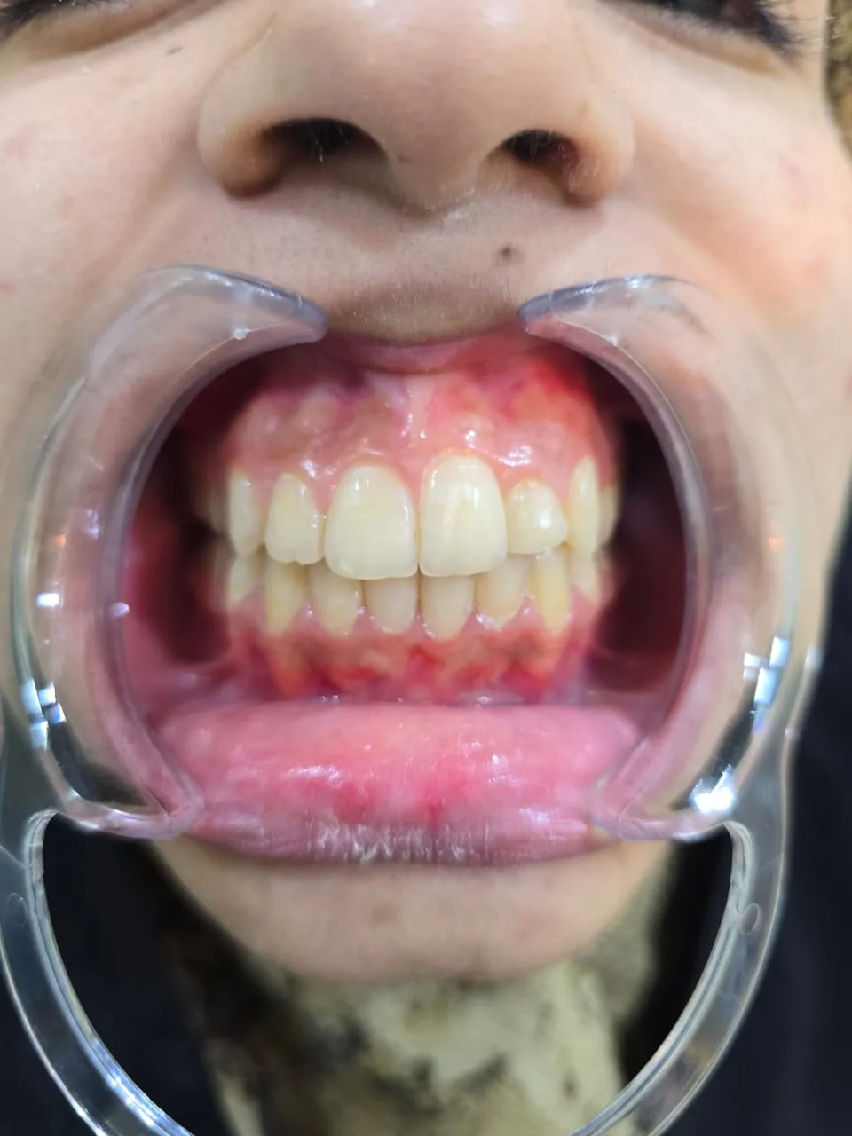 Single tooth crossbite — After