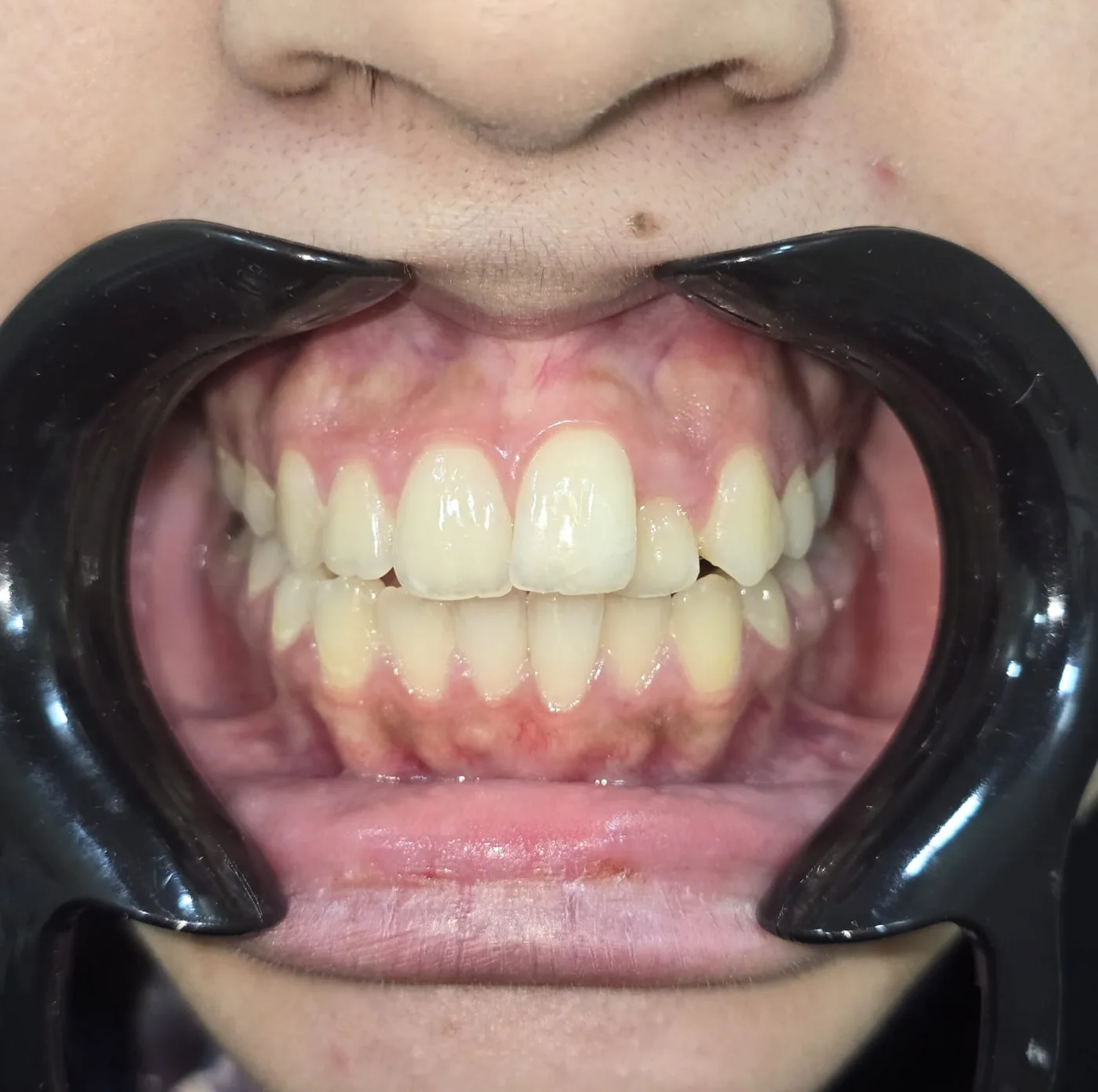 Single tooth crossbite — Before