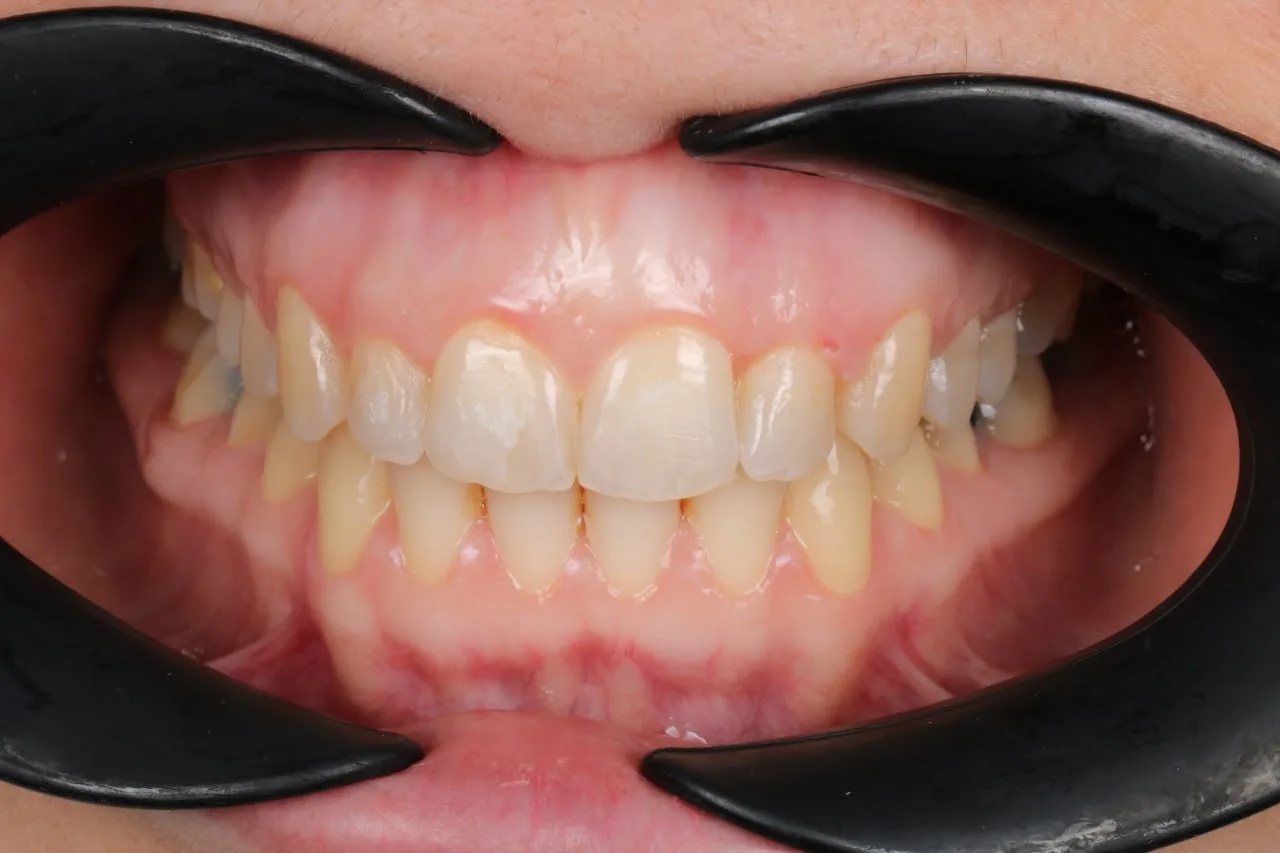 Clear aligner case — After