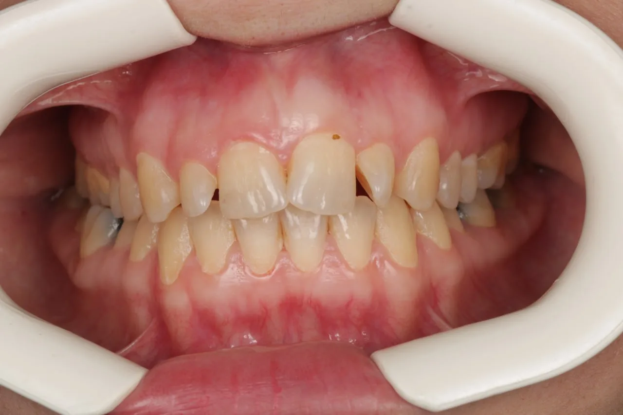 Clear aligner case — Before