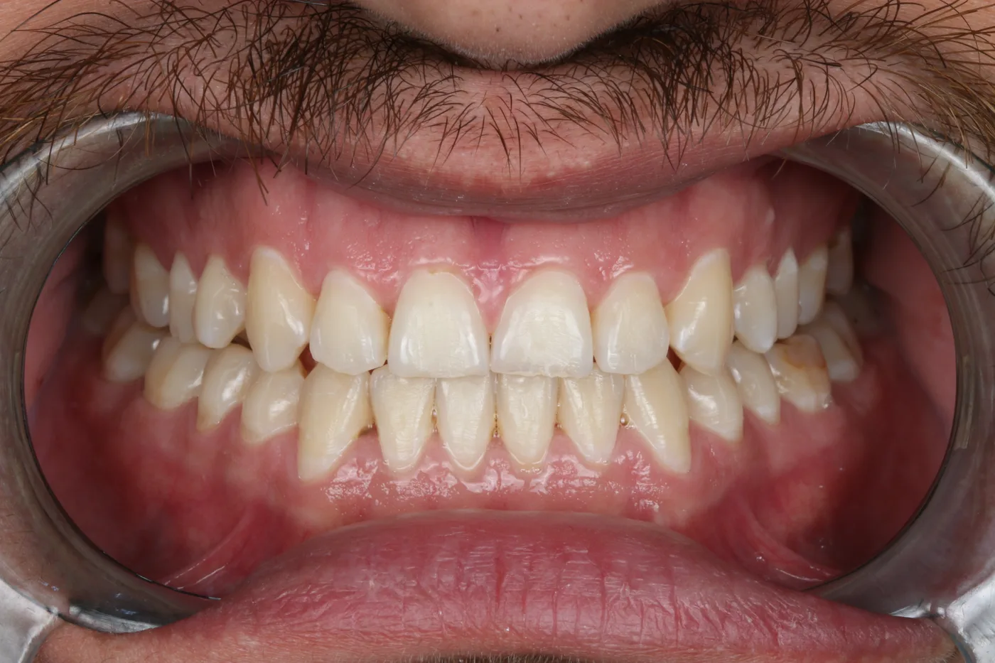 Clear aligner case — After