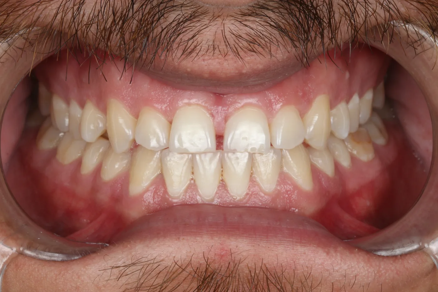 Clear aligner case — Before