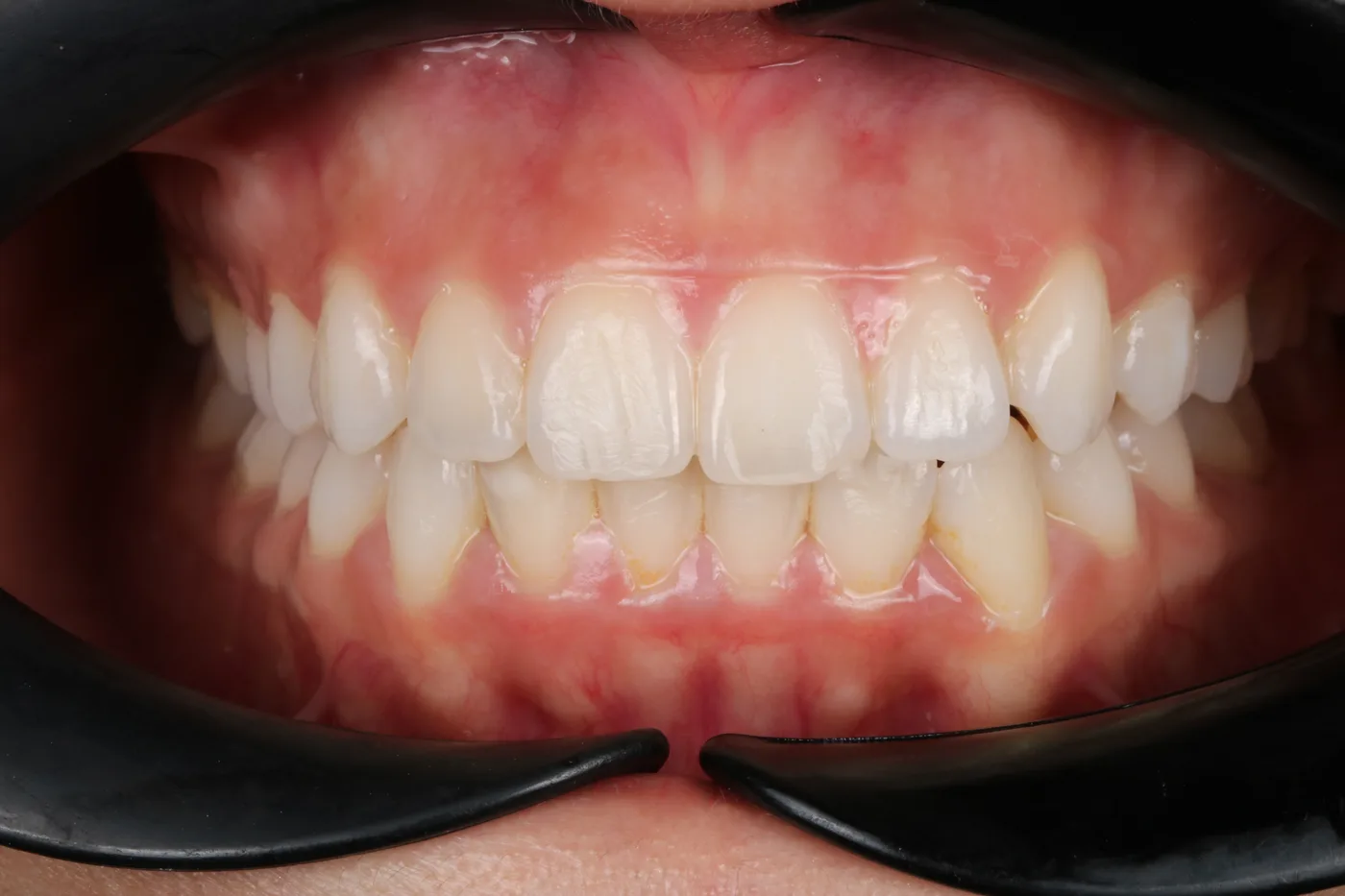 Clear aligner case — After