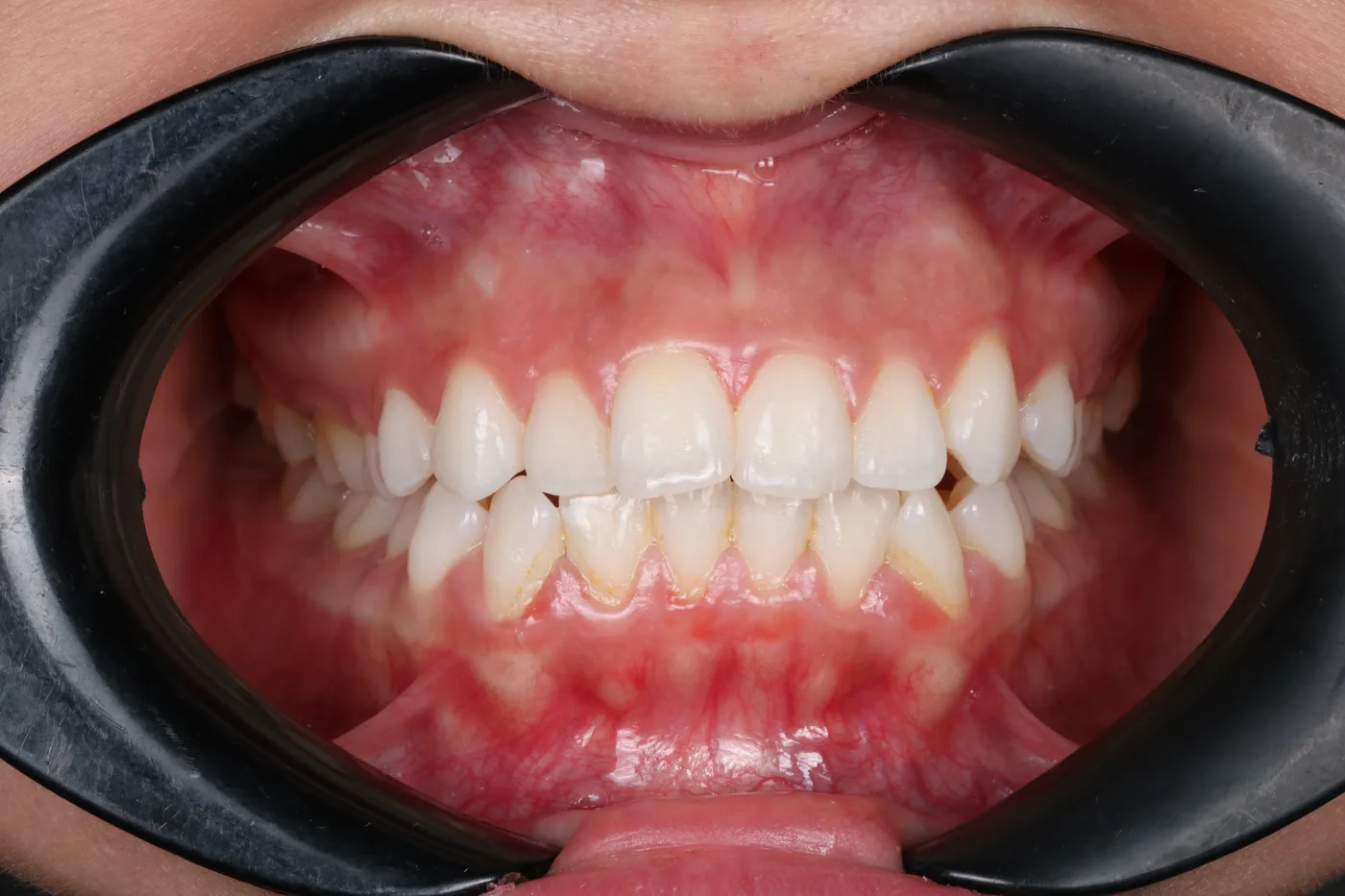 Clear aligner case — Before