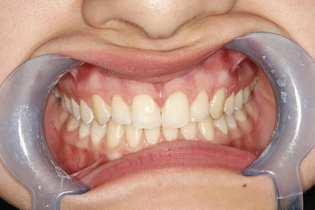 Clear aligner case — After