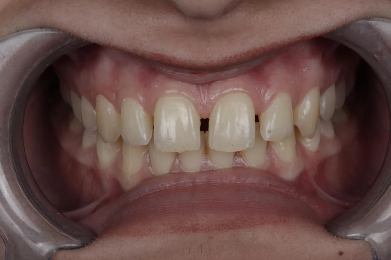 Clear aligner case — Before