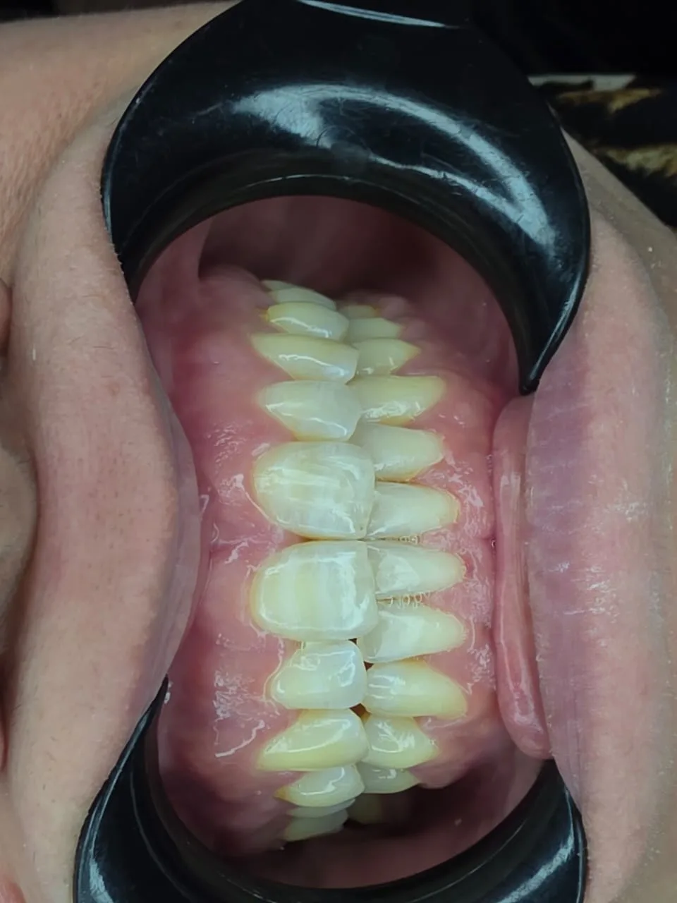 Median diastema — After
