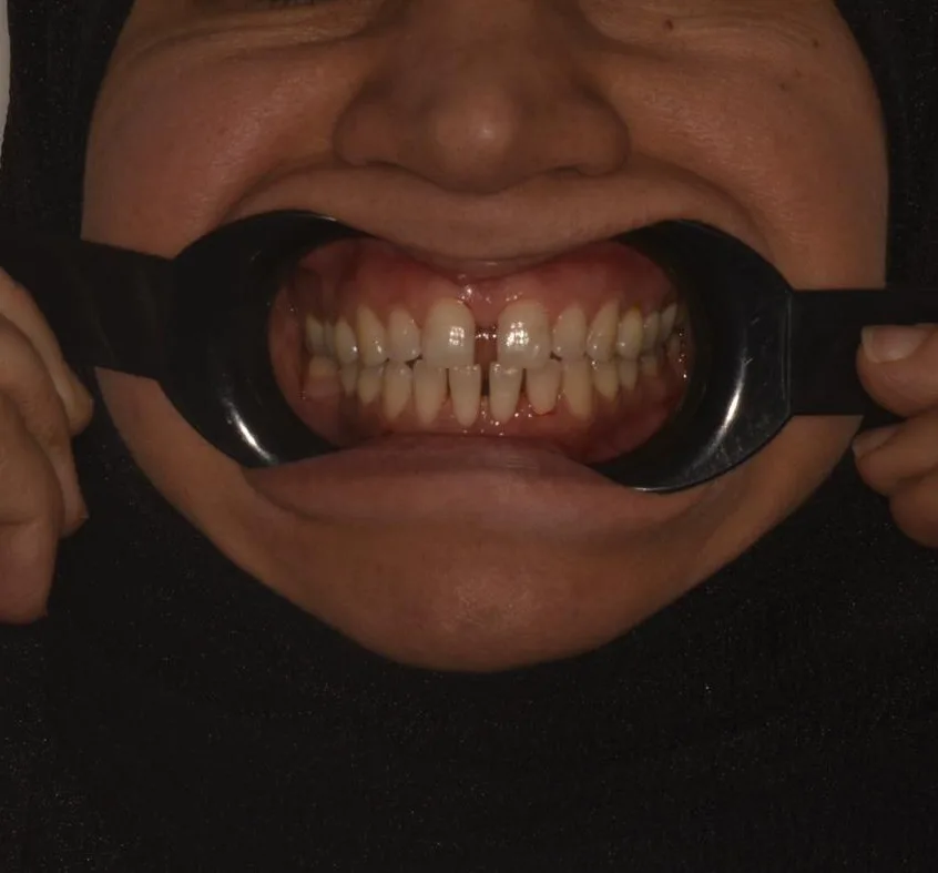 Median diastema — Before