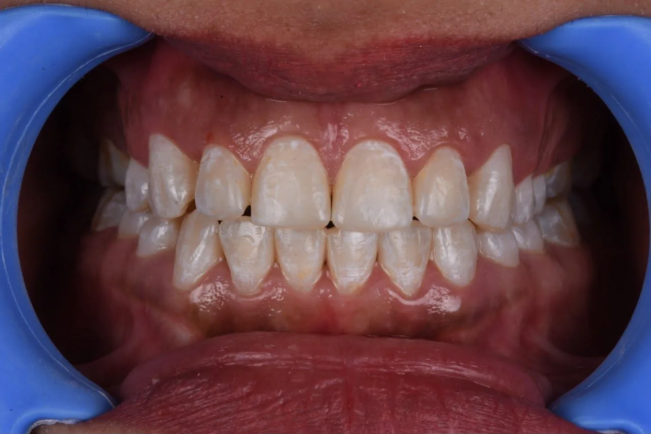 Clear aligner case — After