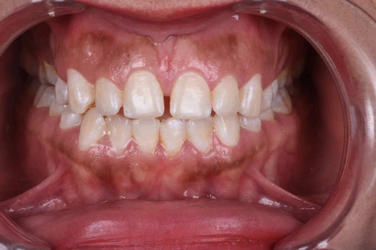Clear aligner case — Before